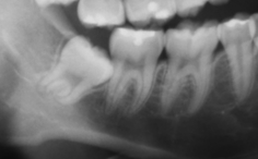 第3大臼歯